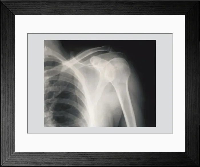 Framed Print : Shoulder, Medical - Xray / Radiology Framed Print : Shoulder, Medical - Xray / Radiology