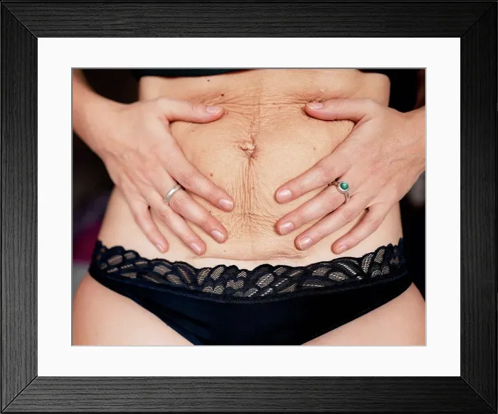 Framed Print : Postpartum flabby and wrinkled belly skin with c-section scar