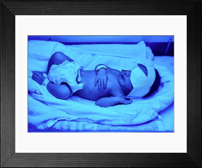 Framed Print : Blue light treatment for baby with jaundice Framed Print : Blue light treatment for baby with jaundice
