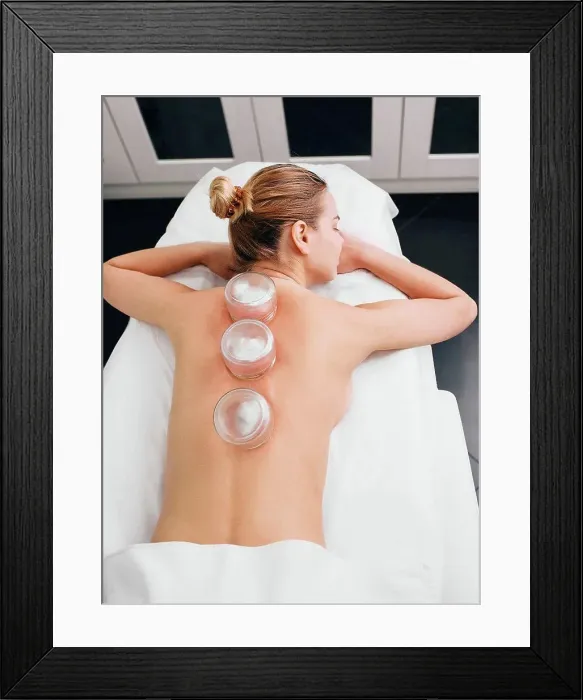 Framed Print : Cupping therapy