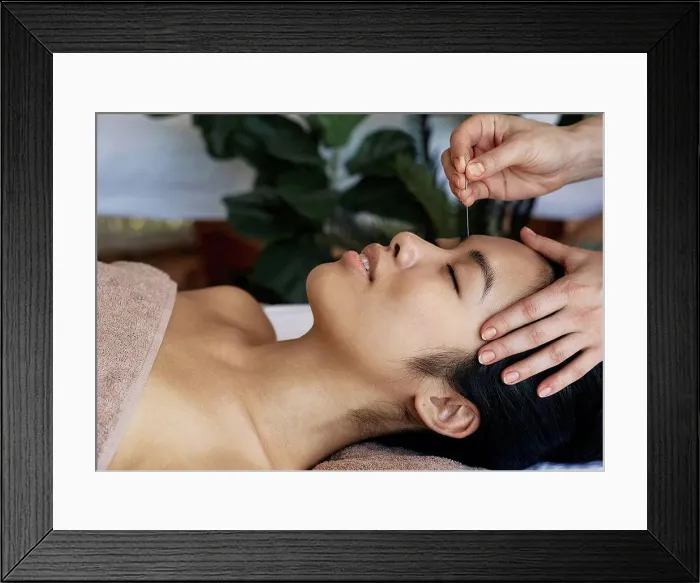 Framed Print : Acupuncture treatment for migraines and headaches Framed Print : Acupuncture treatment for migraines and headaches