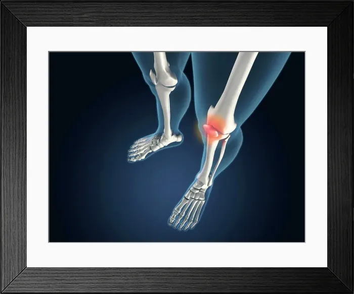 Framed Print : X-ray view of knees with joint inflammations Framed Print : X-ray view of knees with joint inflammations