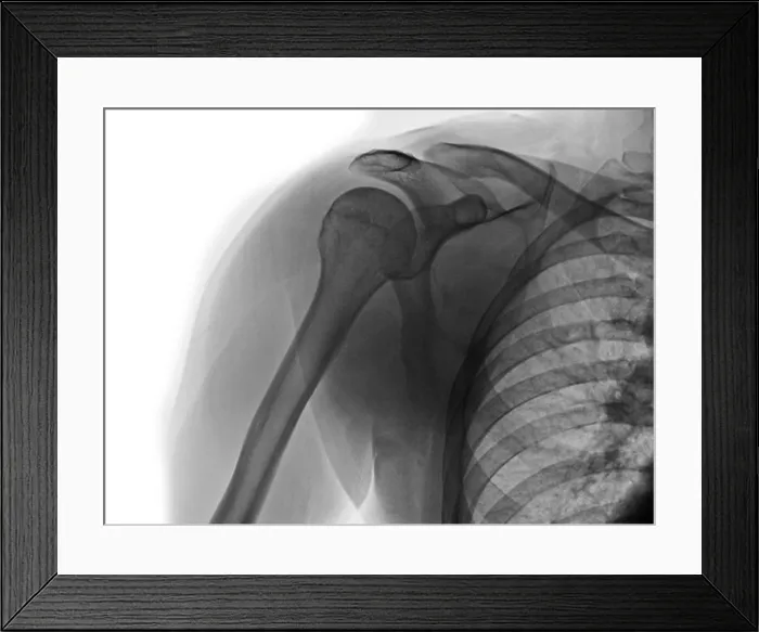 Framed Print : Normal x-ray of the shoulder of a 30 year old man Framed Print : Normal x-ray of the shoulder of a 30 year old man
