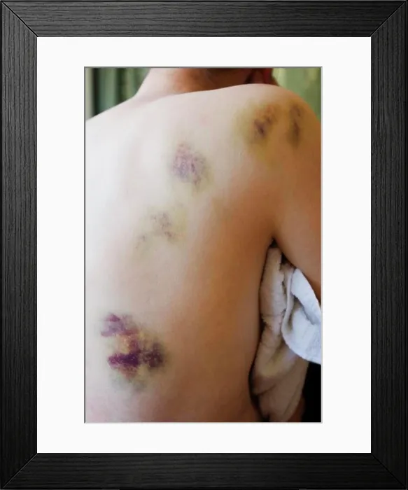 Framed Print : Bruising on a woman's back and shoulder Framed Print : Bruising on a woman's back and shoulder
