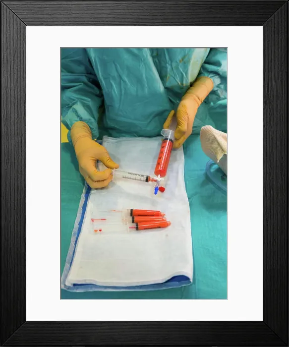 Framed Print : Breast reconstruction by autologous fat cells Framed Print : Breast reconstruction by autologous fat cells