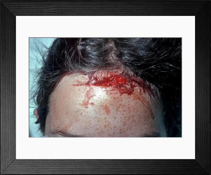 Framed Print : Blunt injury - wound to forehead Framed Print : Blunt injury - wound to forehead