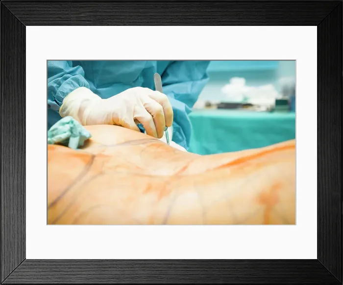 Framed Print : Cosmetic surgery clinic. Buttock lipofilling Framed Print : Cosmetic surgery clinic. Buttock lipofilling