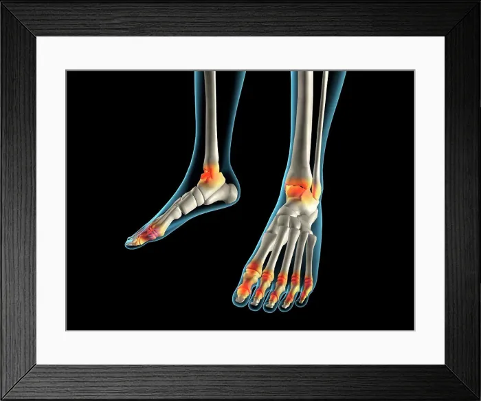 Framed Print : X-ray view of inflamed foot bones Framed Print : X-ray view of inflamed foot bones