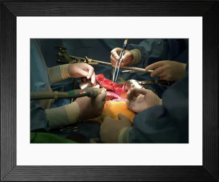 Framed Print : Surgeons performing liver transplant Framed Print : Surgeons performing liver transplant