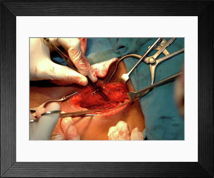 Framed Print : Surgeons removing goitre from patient. Close-up