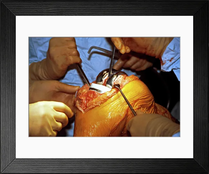 Framed Print : Surgeons performing a total right knee replacement operation in an operating theatre Framed Print : Surgeons performing a total right knee replacement operation in an operating theatre