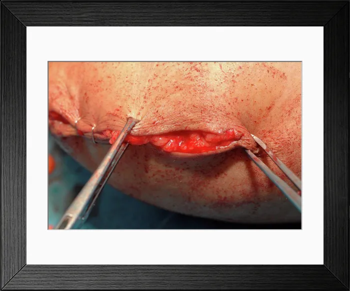 Framed Print : Clamps are released individually so skin can be closed