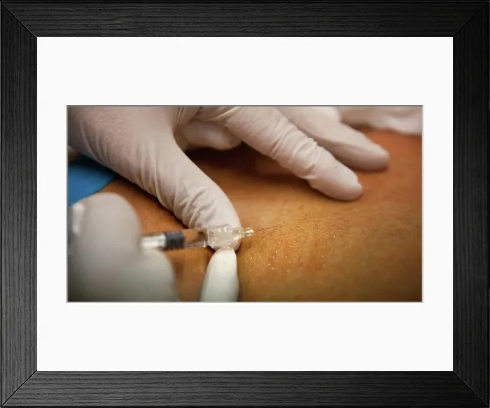 Framed Print : General practitioner practicing mesotherapy and injecting hyaluronic acid into a patient Framed Print : General practitioner practicing mesotherapy and injecting hyaluronic acid into a patient