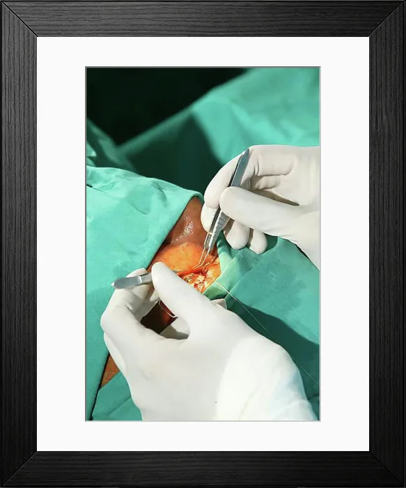 Framed Print : Cataract surgery performed in an operating room in Pietermaritzburg, South Africa, Africa Framed Print : Cataract surgery performed in an operating room in Pietermaritzburg, South Africa, Africa
