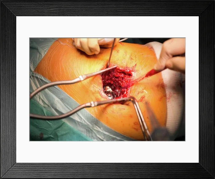 Framed Print : Reportage in the orthopedic surgery service in Saint George Clinic