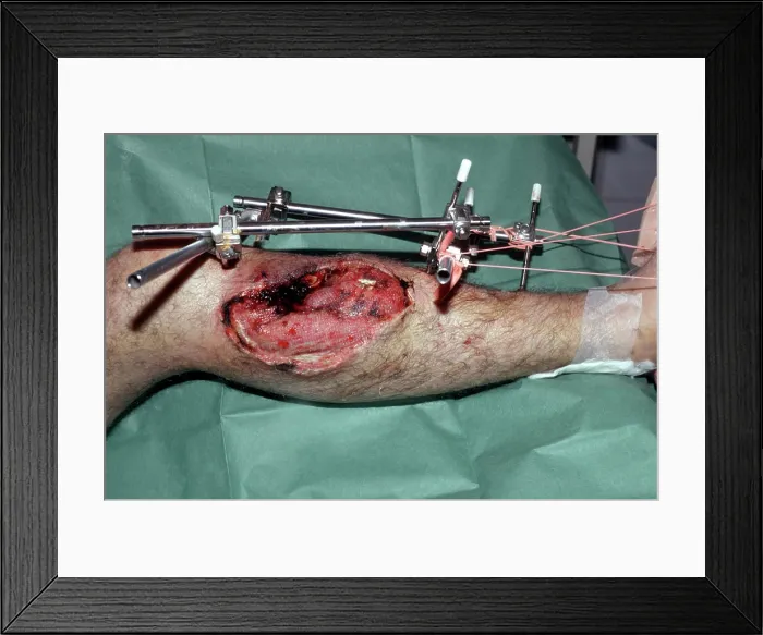 Framed Print : External metal fixation of a lower leg fracture Framed Print : External metal fixation of a lower leg fracture