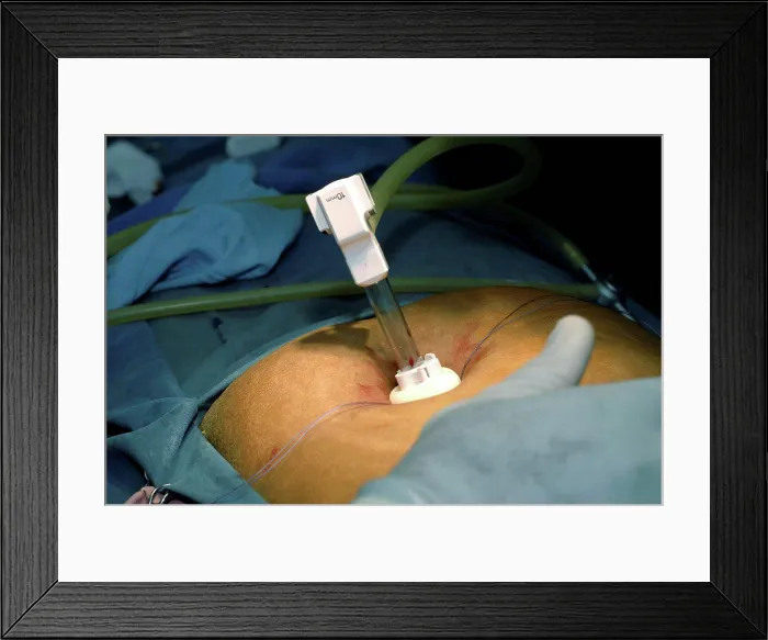 Framed Print : Surgeon performing Cholecystectomy (gall bladder removal)
