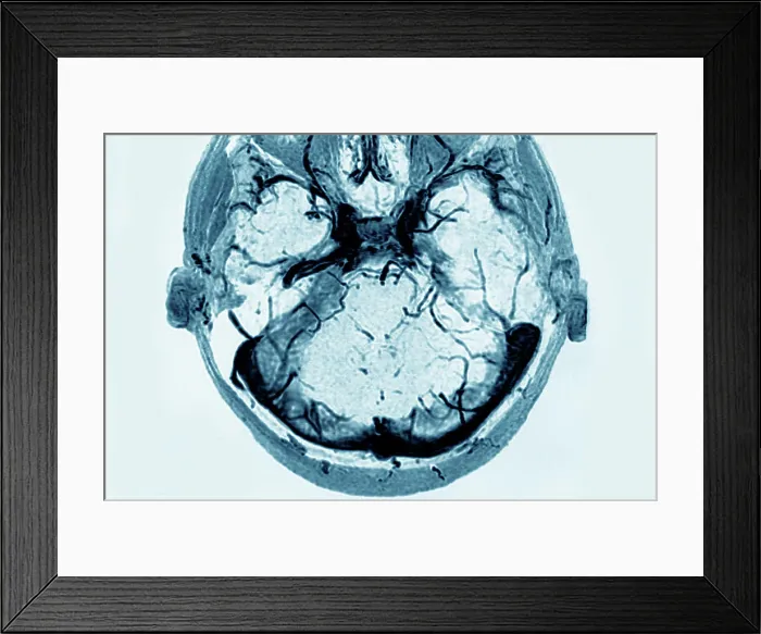 Framed Print : Cerebral venous thrombosis of the left transverse sinus. Radial section brain CTA scan Framed Print : Cerebral venous thrombosis of the left transverse sinus. Radial section brain CTA scan