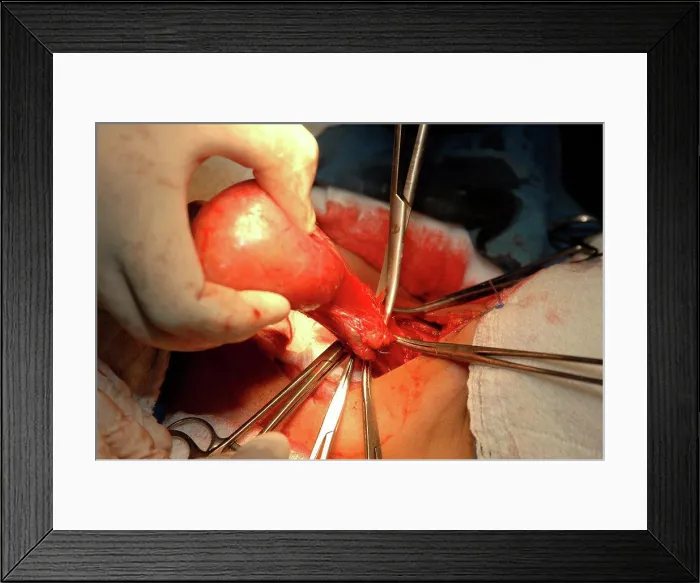 Framed Print : Surgeons removing goitre from patient