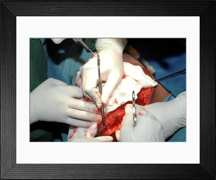 Framed Print : Surgeons establishing haemostasis masectomy and axillary Framed Print : Surgeons establishing haemostasis masectomy and axillary
