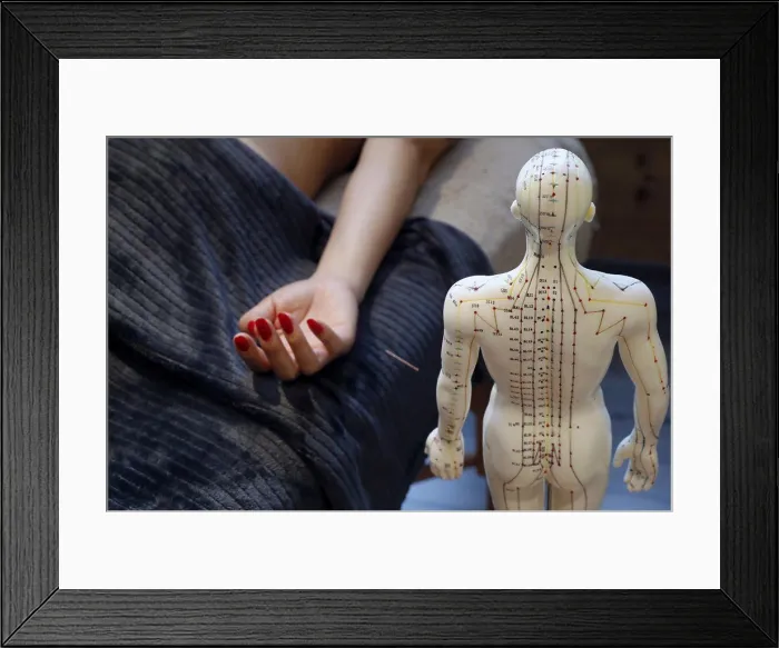 Framed Print : Traditional chinese medecine. A male model with marked acupuncture points. Woman receving acupuncture needle. France