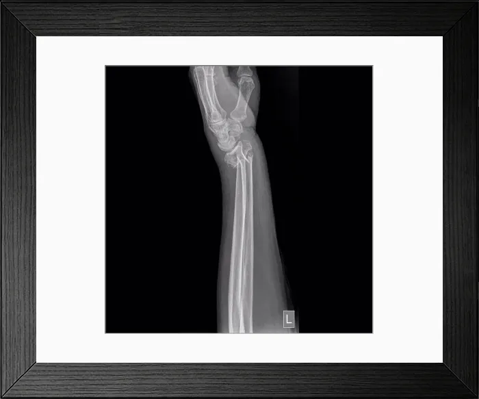 Framed Print : Colles fracture, X-ray Framed Print : Colles fracture, X-ray
