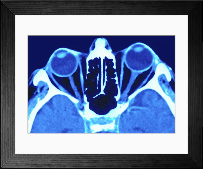 Framed Print : Two eyes and their optic nerves, seen on a radial section scan Framed Print : Two eyes and their optic nerves, seen on a radial section scan
