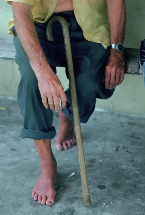 Framed Print : The barefeet of an elderly man Framed Print : The barefeet of an elderly man