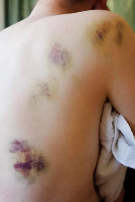 Framed Print : Bruising on a woman's back and shoulder Framed Print : Bruising on a woman's back and shoulder