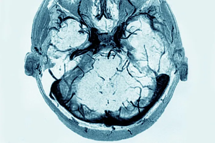 Framed Print : Cerebral venous thrombosis of the left transverse sinus. Radial section brain CTA scan Framed Print : Cerebral venous thrombosis of the left transverse sinus. Radial section brain CTA scan