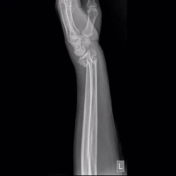 Framed Print : Colles fracture, X-ray Framed Print : Colles fracture, X-ray