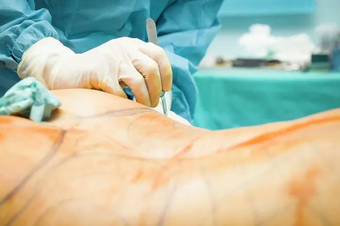 Framed Print : Cosmetic surgery clinic. Buttock lipofilling Framed Print : Cosmetic surgery clinic. Buttock lipofilling