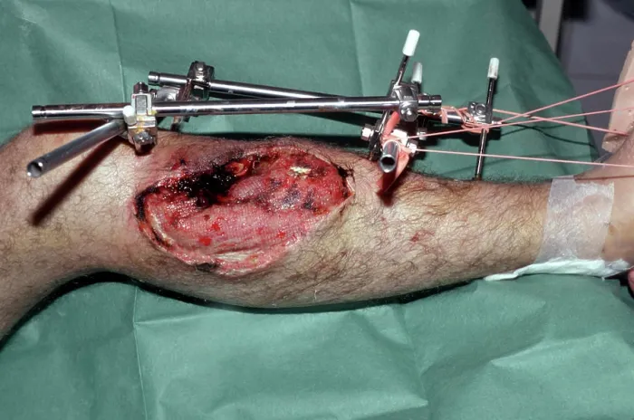 Framed Print : External metal fixation of a lower leg fracture Framed Print : External metal fixation of a lower leg fracture