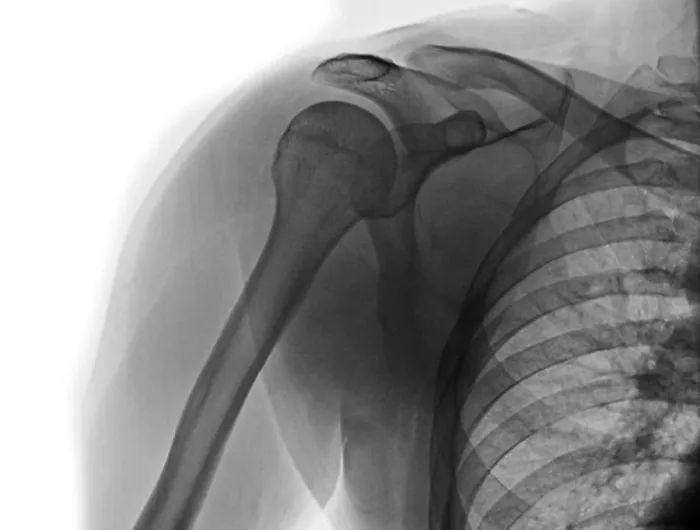 Framed Print : Normal x-ray of the shoulder of a 30 year old man Framed Print : Normal x-ray of the shoulder of a 30 year old man