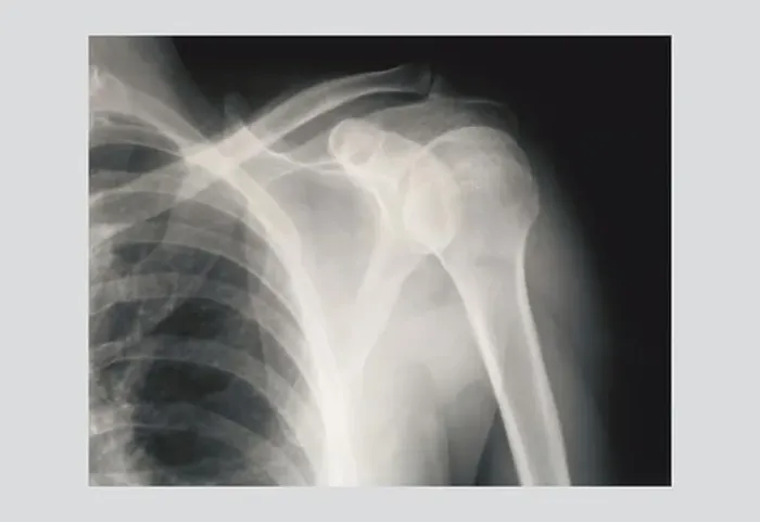 Framed Print : Shoulder, Medical - Xray / Radiology Framed Print : Shoulder, Medical - Xray / Radiology