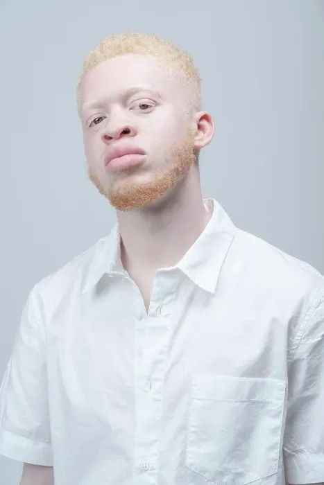 Framed Print : Studio portrait of albino man in white shirt Framed Print : Studio portrait of albino man in white shirt