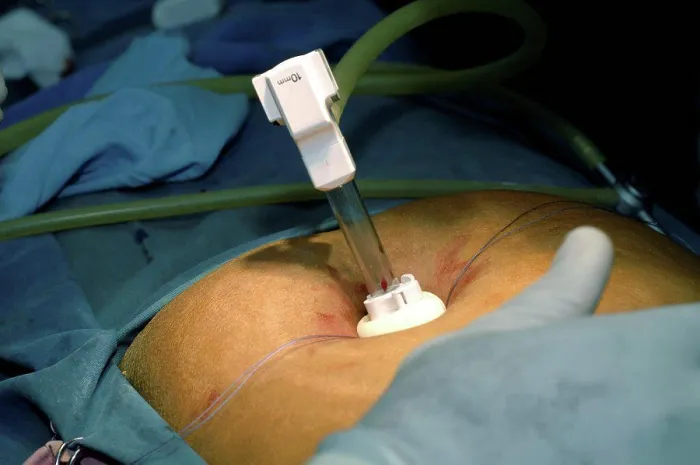 Framed Print : Surgeon performing Cholecystectomy (gall bladder removal)