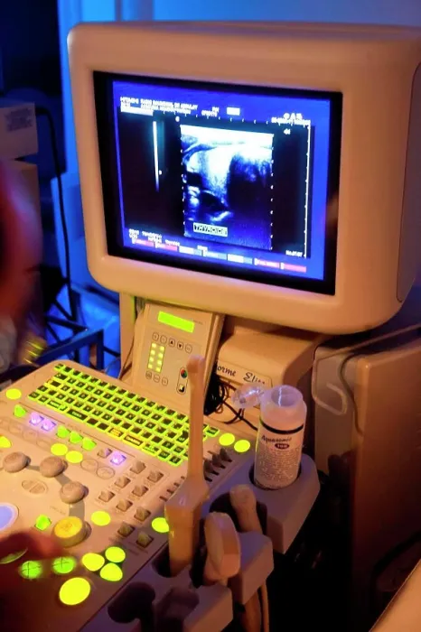 Framed Print : Thyroid ultrasound Framed Print : Thyroid ultrasound