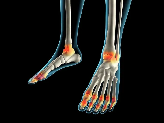 Framed Print : X-ray view of inflamed foot bones Framed Print : X-ray view of inflamed foot bones