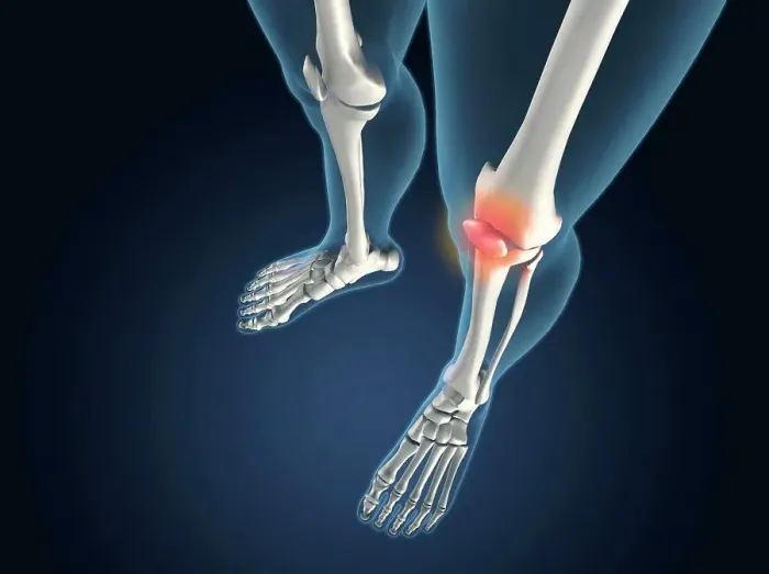 Framed Print : X-ray view of knees with joint inflammations Framed Print : X-ray view of knees with joint inflammations