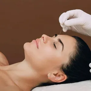 Acupuncture Acupuncture