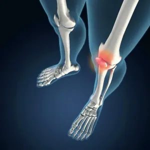 X-ray view of knees with joint inflammations X-ray view of knees with joint inflammations