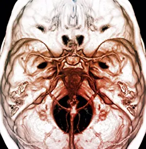 X Ray Prints: Arteries of the brain. 3D computed tomography (CT) angio scan of normal arteries in the brain of a 38 year old