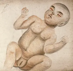 Eyes Prints: A baby girl with infected eyes