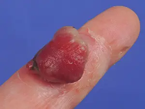 Finger Prints: Botryomycosis of the index finger