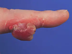 Finger Prints: Botryomycosis of the index finger