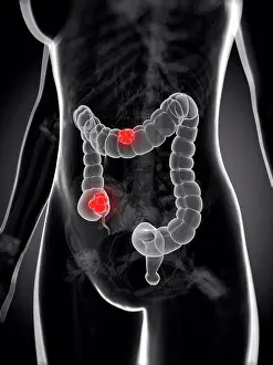 Human Body Prints: Bowel cancer, artwork