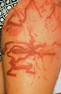 Injured Prints: Box jellyfish, Sting Scars North Queensland, Australia