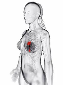 Top Section Prints: Breast cancer, artwork