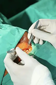 Expert Prints: Cataract surgery performed in an operating room in Pietermaritzburg, South Africa, Africa